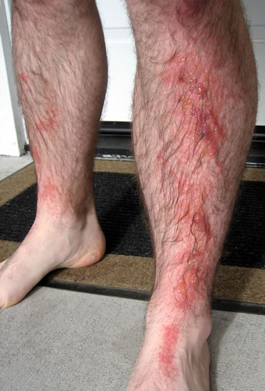 pictures of poison sumac rash. thing about poison-oak