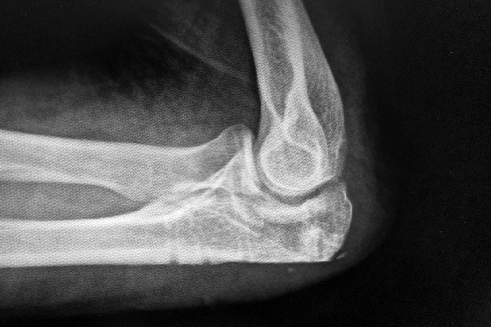 X-ray of Justin's left elbow after metal implant was removed