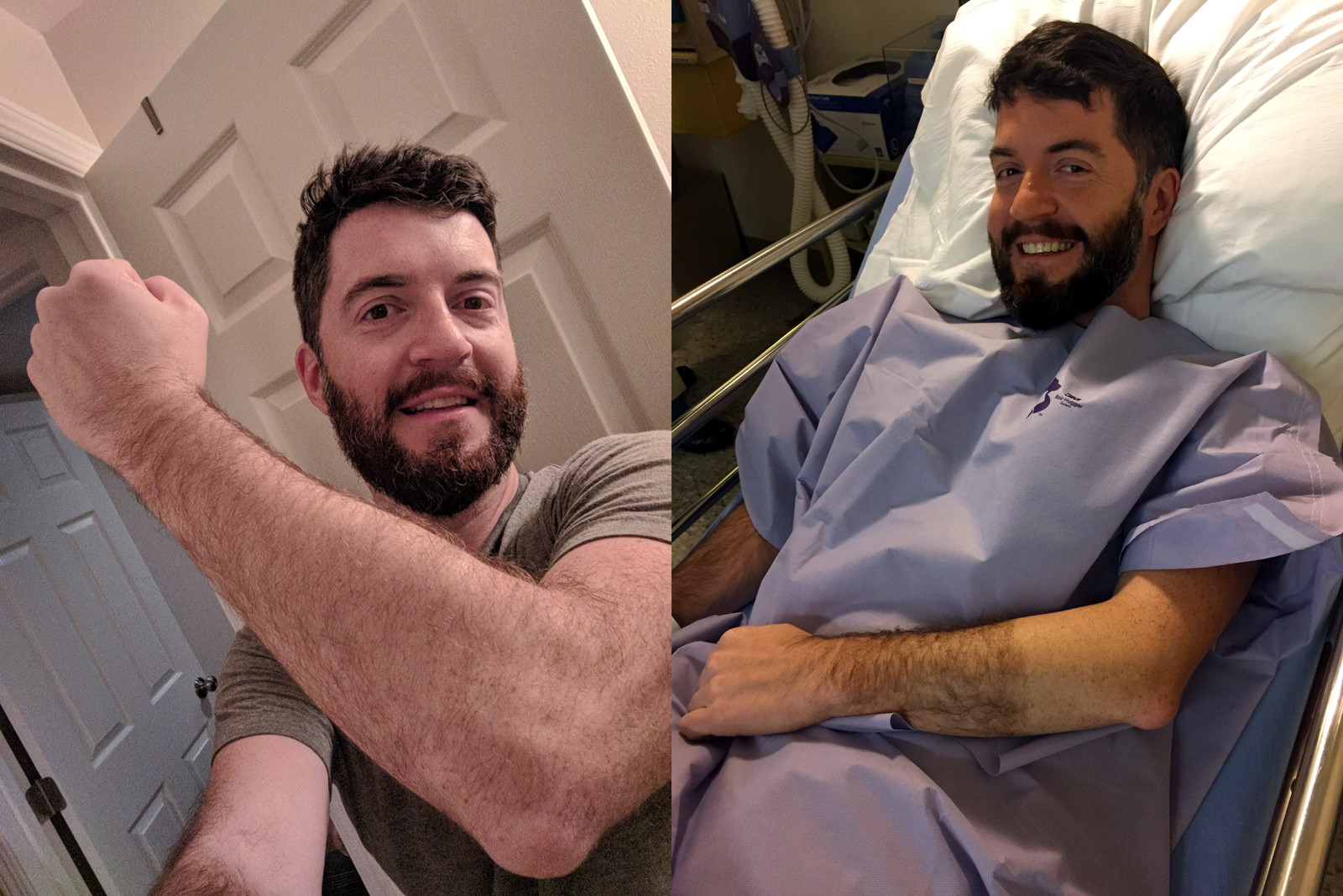Justin metal elbow selfie and shaved arm before surgery